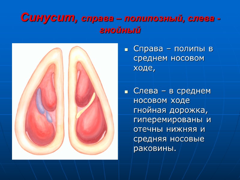 Синусит, справа – полипозный, слева - гнойный Справа – полипы в среднем носовом ходе,